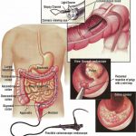 Lower Endoscopy or Colonoscopy